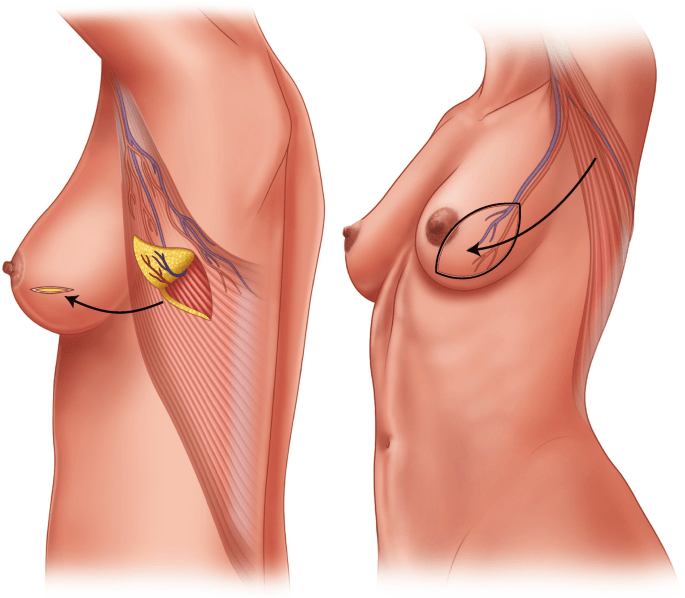 Volume replacement from your own tissue — no muscle&nbsp;sacrificed.