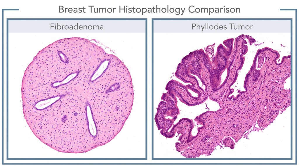 Understanding Breast Lumps: Fibroadenoma vs.&nbsp;Phyllodes