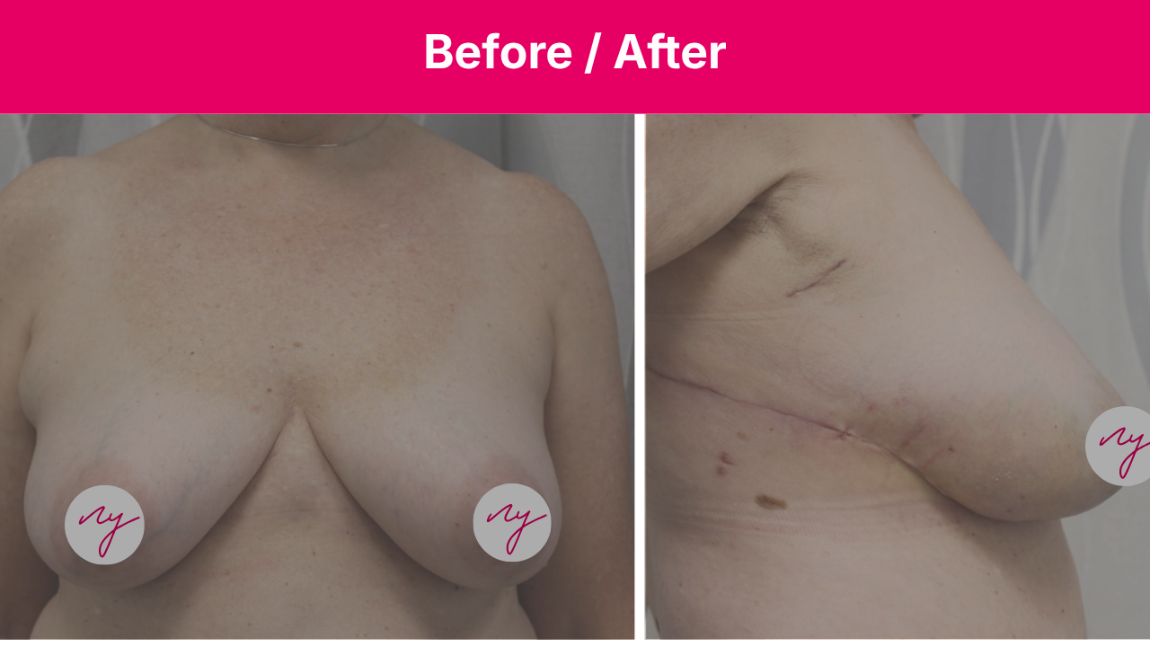 Before and after: Lateral Intercostal Artery Perforator Flap for Partial Breast Reconstruction after Invasive Ductal Carcinoma with DCIS